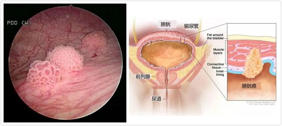 癌 症状 膀胱