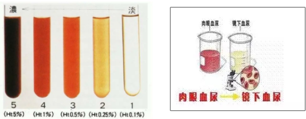 [最も人気のある！] 血尿 画像 175915